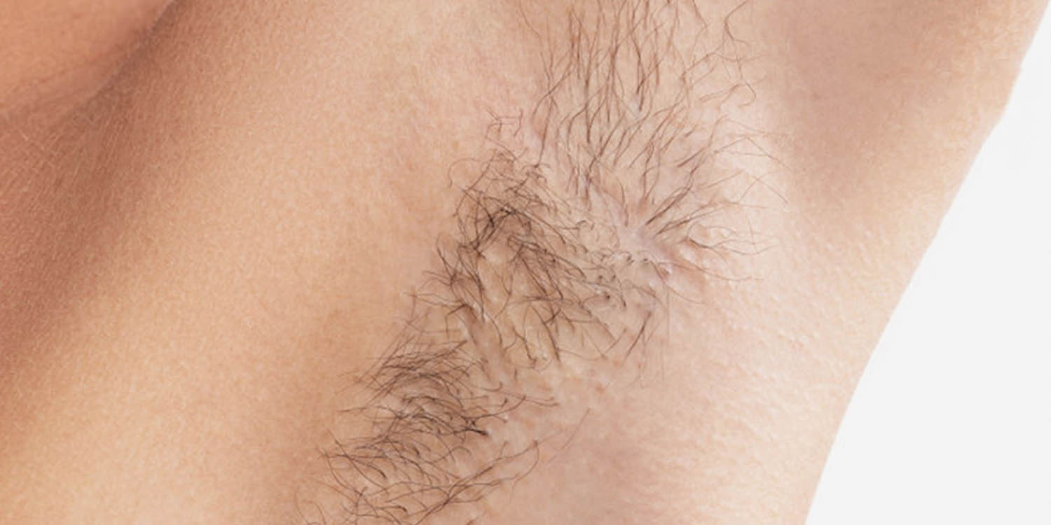 Before 2 or 3 weeks - HIKYSKIN